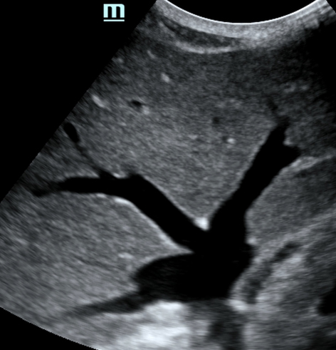 fluid overload ultrasound image